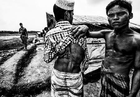 Rohingya-Flüchtling zeigt den Einschlag einer Kugel im Körper seines Freundes – Bangladesch